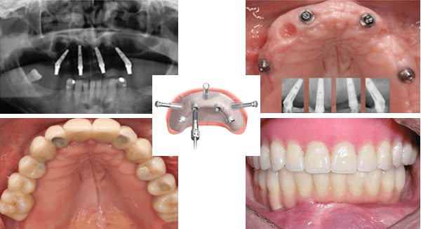 Những lưu ý sau khi trồng răng Implant All On 4