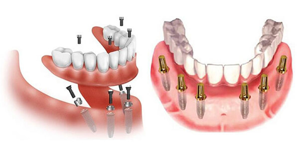 Địa chỉ trồng răng implant all on 4 uy tín, chuyên nghiệp, giá tốt
