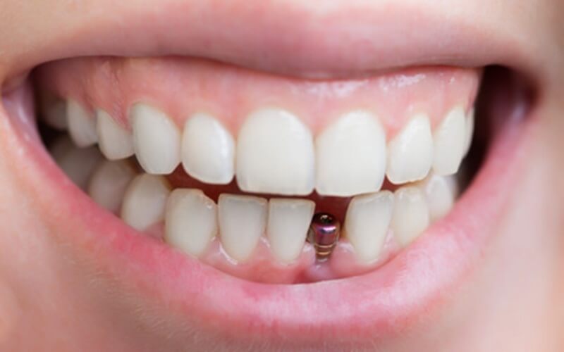 Cấy ghép răng Implant đơn lẻ với chất liệu cao cấp