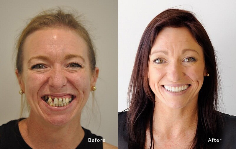 Sau khi cấy răng Implant khách hàng có nụ cười xinh hơn