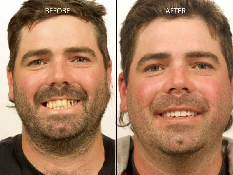 Giải pháp trồng răng Implant giúp khắc phục mọi nhược điểm của răng