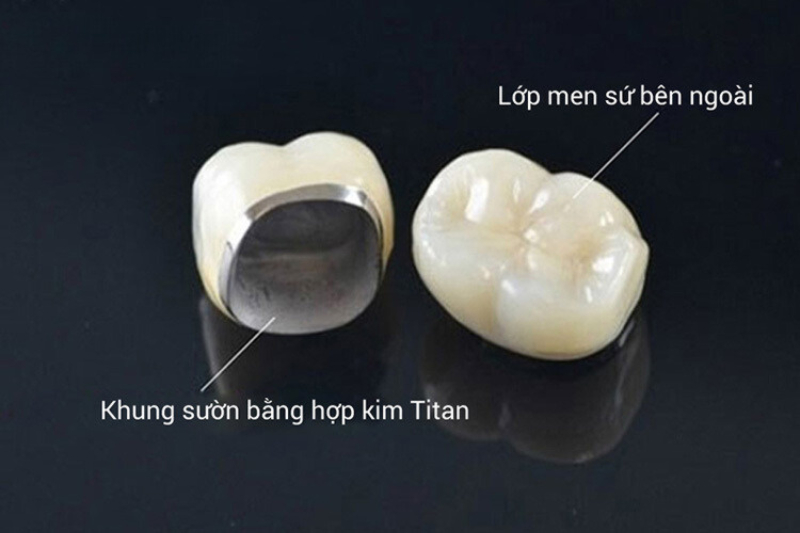 Răng sứ kim loại có lõi từ kim loại (titan) và lớp sứ bền bỉ bên ngoài