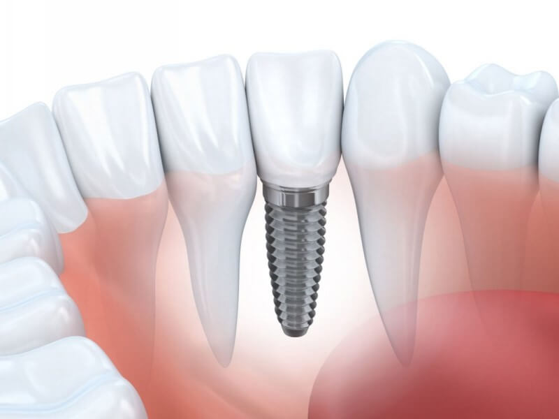 Trồng răng implant có thực sự nguy hiểm không?