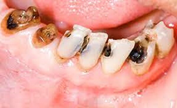 Tình trạng sâu răng, xỉn màu, sứt mẻ đều có thể áp dụng kỹ thuật này