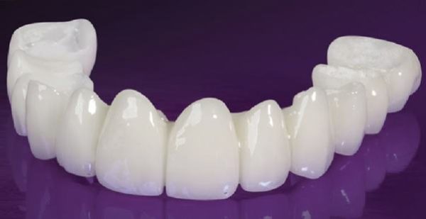 Giá răng sứ Cercon HT thường khá cao nhưng có chất lượng xứng đáng