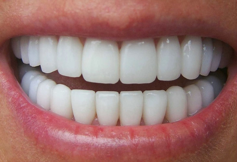 Các lý do không nên trồng răng sứ giá rẻ