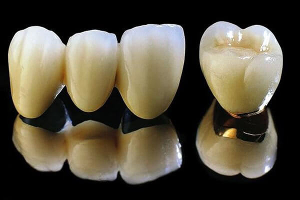 Giá trồng răng sứ Titan giá rẻ - an toàn tại Cường Nhân