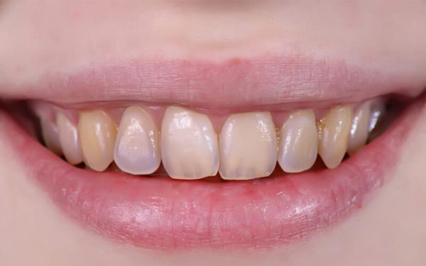 Răng xỉn màu, sứt mẻ hay cấu tạo phức tạp có thể sử dụng phương pháp này