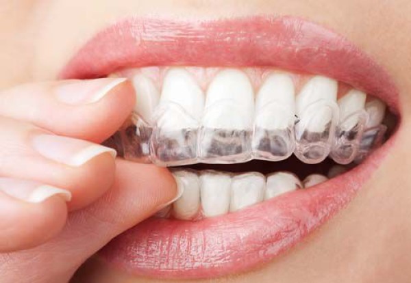 Có bao nhiêu loại niềng răng hiện đại hiện nay ?