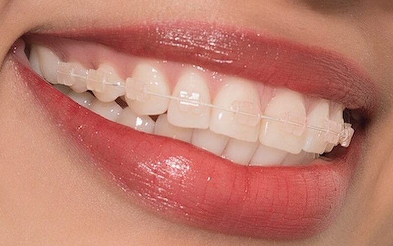 Quy trình niềng răng hiệu quả và an toàn ?