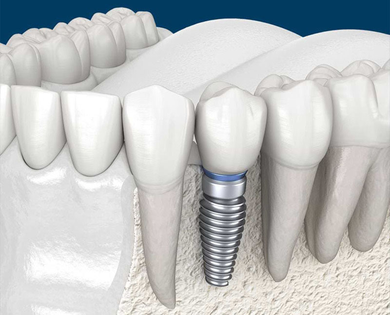 Các yếu tố ảnh hưởng đến việc đau khi trồng răng Implant