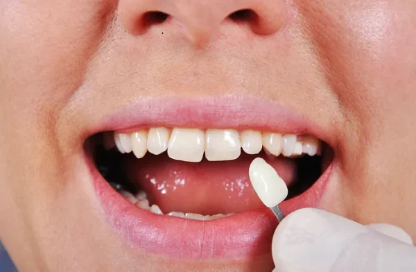 Răng sứ Zirconia đảm bảo tính thẩm mỹ tự nhiên