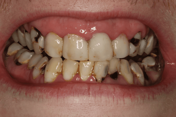 Những người có răng hư hỏng hoặc xỉn màu nặng có thể lựa chọn kỹ thuật này