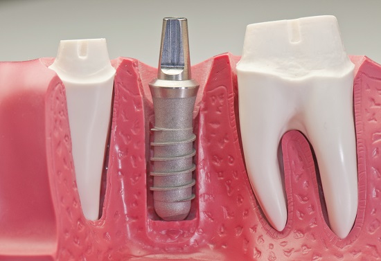 Một trụ răng implant có giá từ 700-1200 USD tùy chất liệu và thương hiệu 