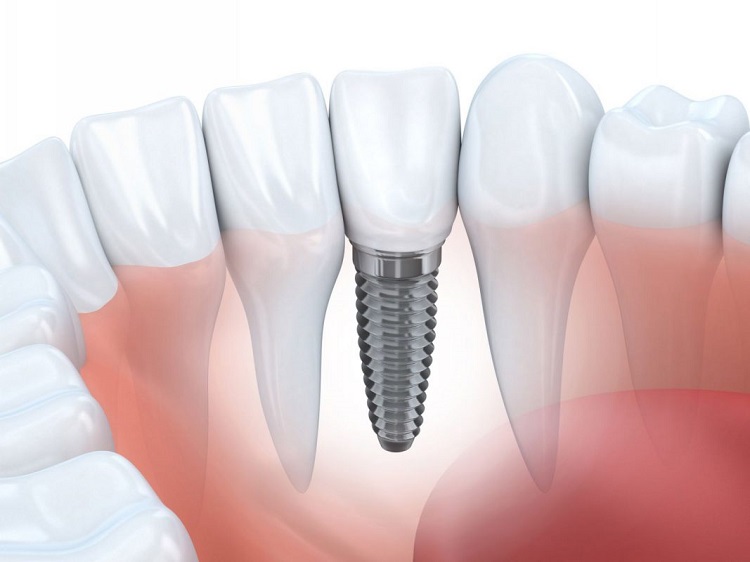 Cấy ghép Implant là một kỹ thuật trồng răng giả