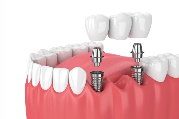 Mỗi bệnh nhân sẽ có một phương pháp phục hình răng tương ứng