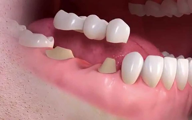 Trồng răng sứ thường có chi phí thấp hơn cắm implant