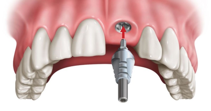 Trồng răng cửa Implant là gì?