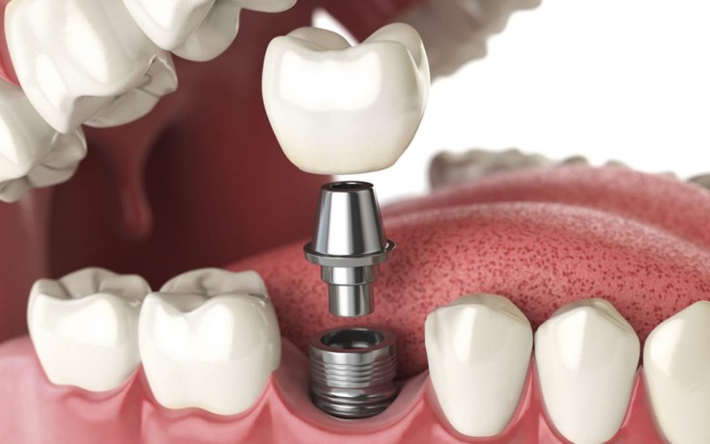 Quy trình trồng răng cửa Implant