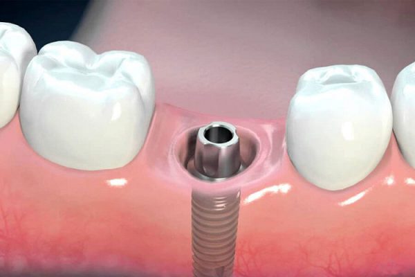Kinh nghiệm trồng răng Implant hiệu quả