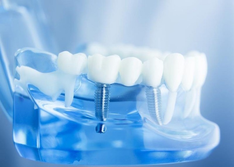 Kiểm tra ổn định răng Implant