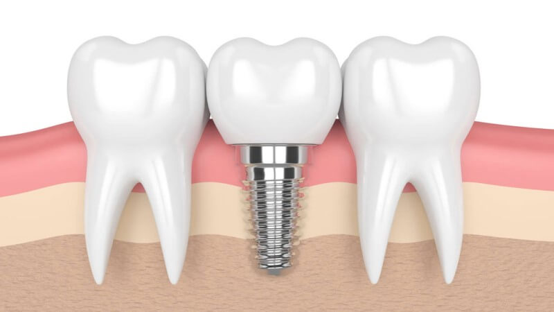 Tại sao sau khi trồng răng implant bị đau?