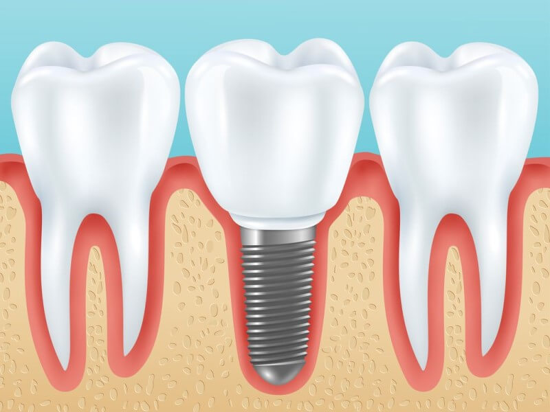 Các nguyên nhân khiến cho răng implant bị đau