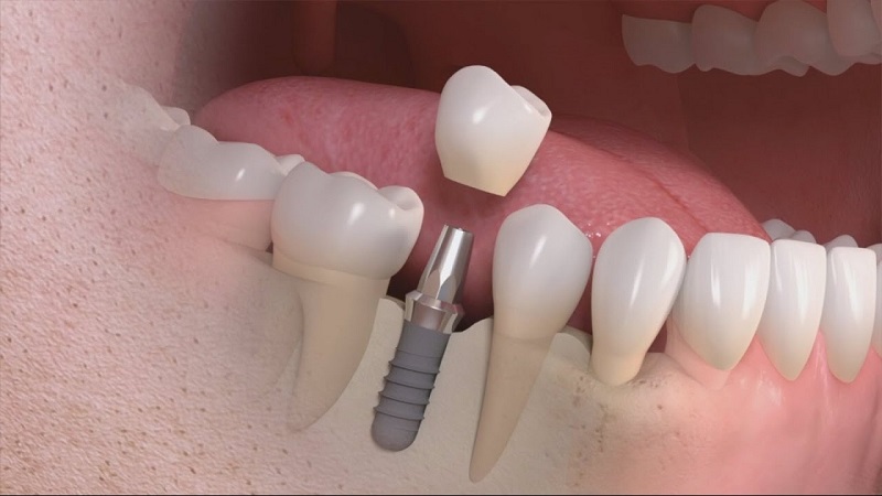 Ưu điểm của trồng răng Implant cho người già