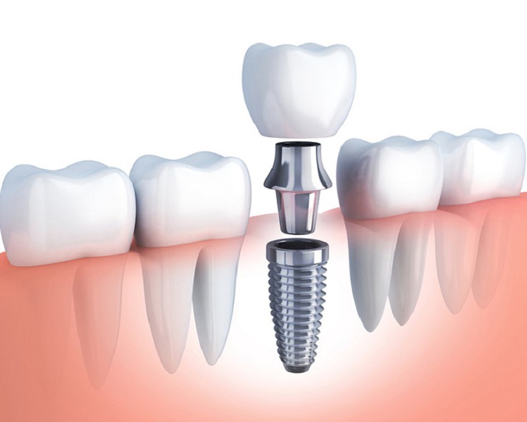 Trồng răng implant có hôi miệng không?