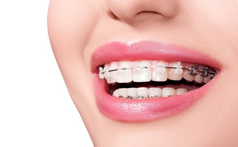 Trồng răng implant có niềng răng được không là câu hỏi của nhiều người