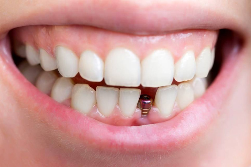 Nên niềng răng trước hay là trồng răng Implant trước? 