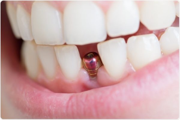 Quy trình niềng răng sau khi trồng răng Implant