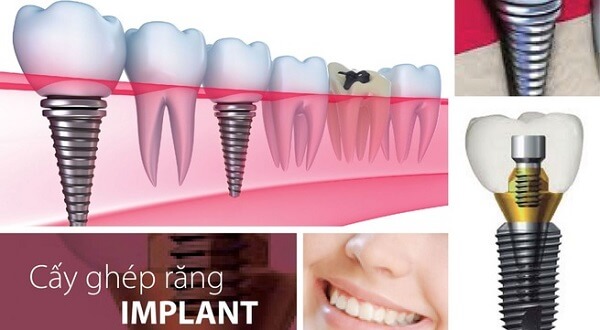 Trồng răng Implant bị sưng mặt thì giải quyết như thế nào ?