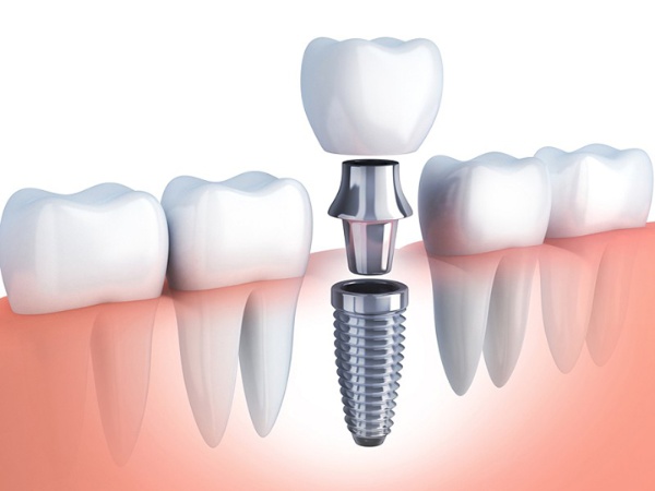 Những ai có răng cần được nhổ bỏ nên trồng răng Implant