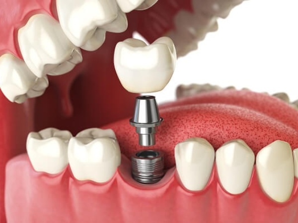 Khi nào thích hợp để trồng răng Implant?