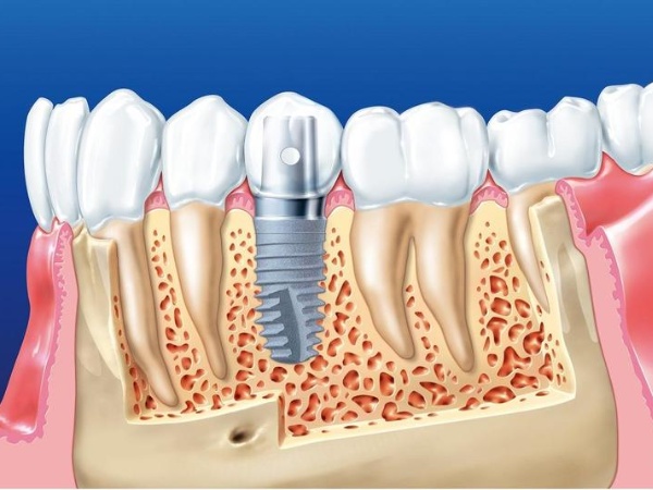 Quy trình thực hiện dịch vụ trồng răng Implant