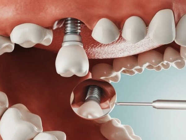 Nha Khoa Cường Nhân - Địa chỉ trồng răng Implant uy tín