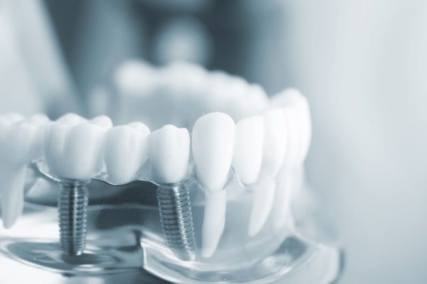 Những trường hợp không nên trồng răng Implant
