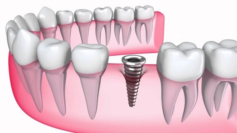 Ưu điểm khi trồng răng Implant