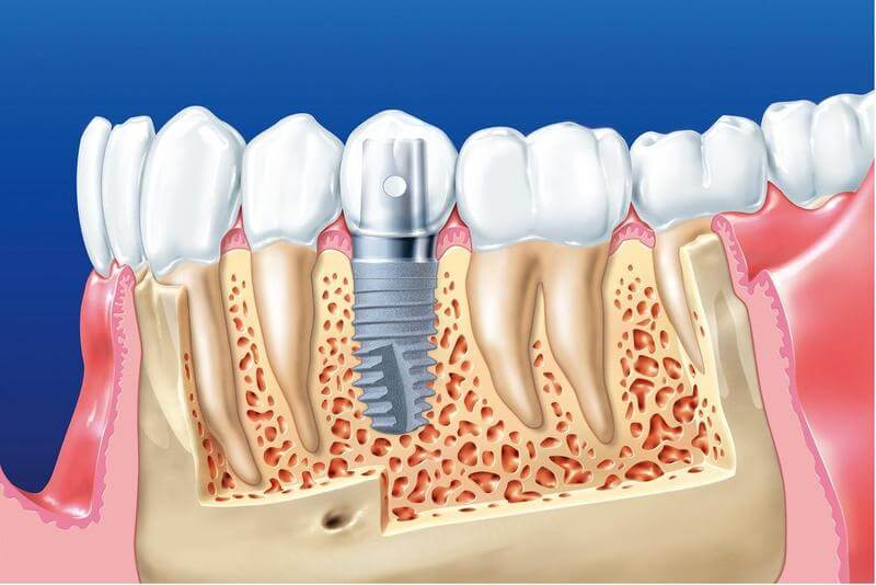 Nhược điểm của việc trồng răng Implant