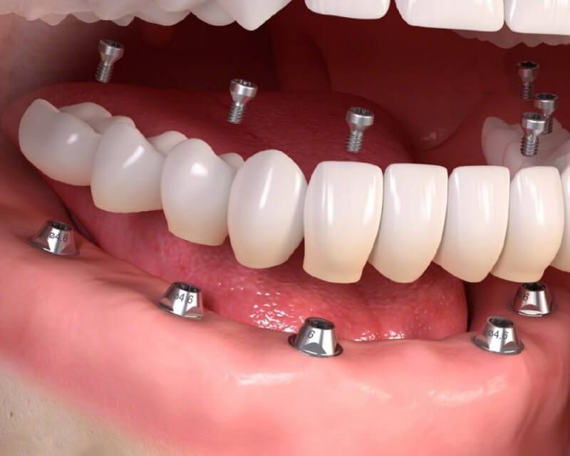 Vùng trồng răng implant bị lung lay