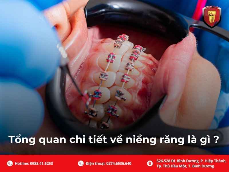 Tổng quan chi tiết về niềng răng là gì ?