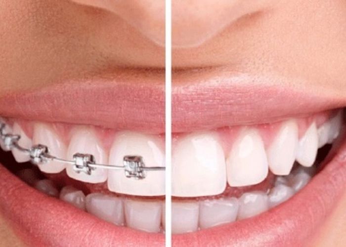 Niềng răng là một cách giúp răng bạn đẹp hơn