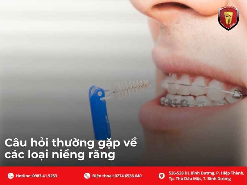 Câu hỏi thường gặp về các loại niềng răng