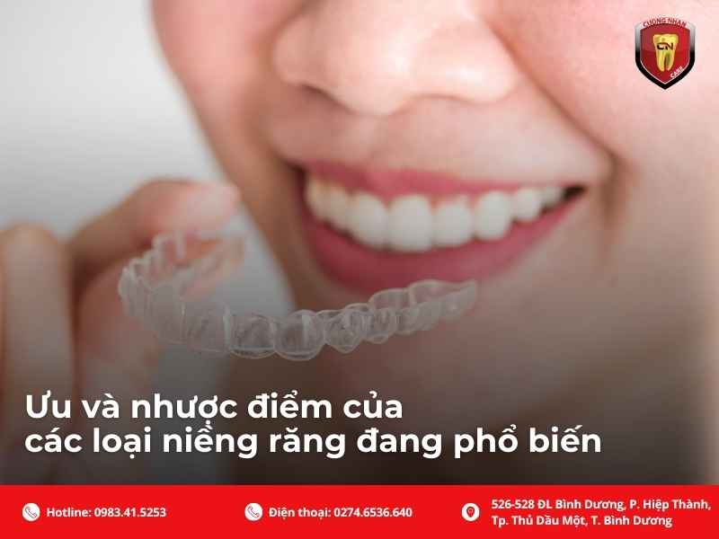 Ưu và nhược điểm của các loại niềng răng đang phổ biến