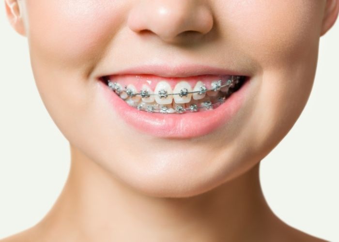 Mắc cài kim loại được sử dụng phổ biến trong niềng răng