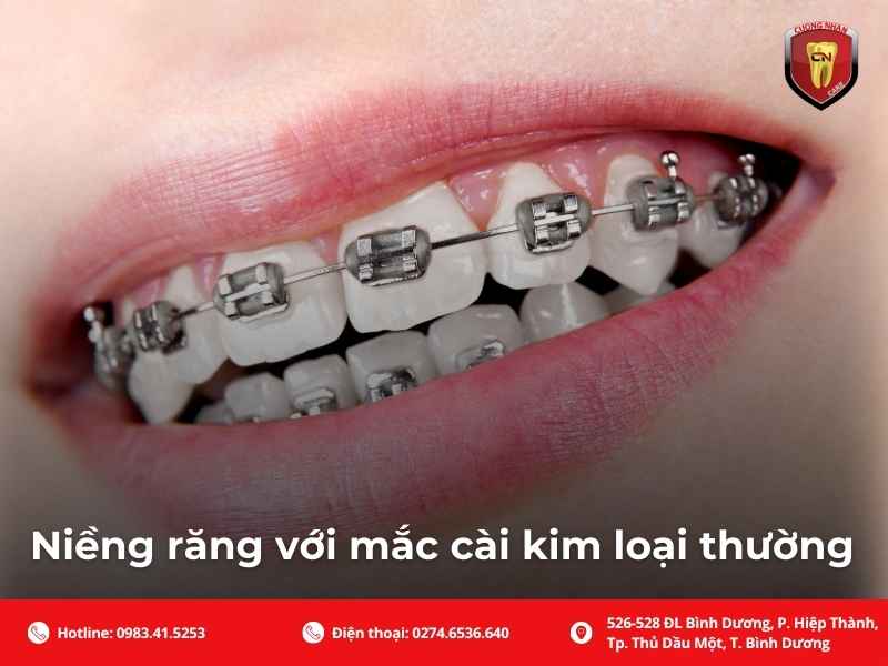 Niềng răng với mắc cài kim loại thường