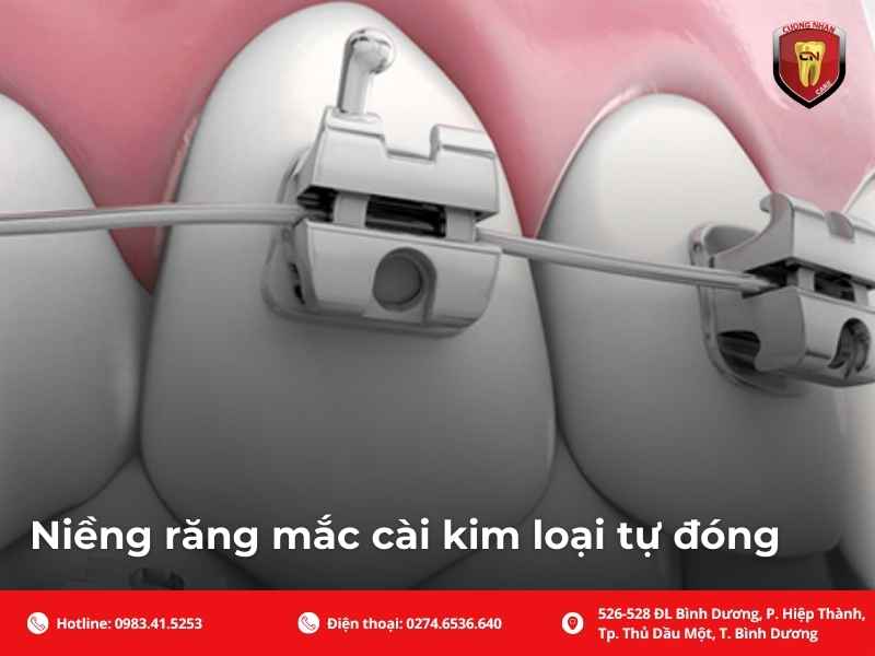 Niềng răng mắc cài kim loại tự đóng