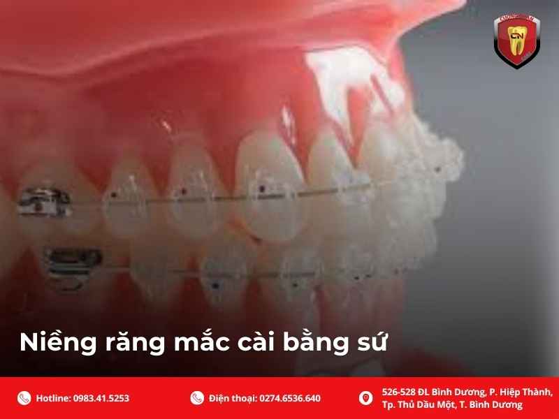 Niềng răng mắc cài bằng sứ