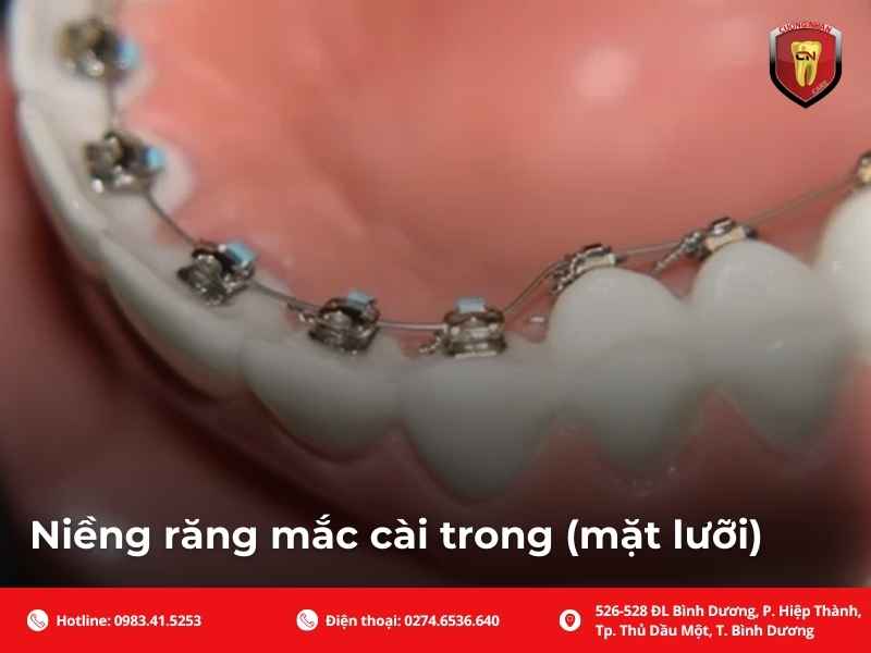Niềng răng mắc cài trong (mặt lưỡi)